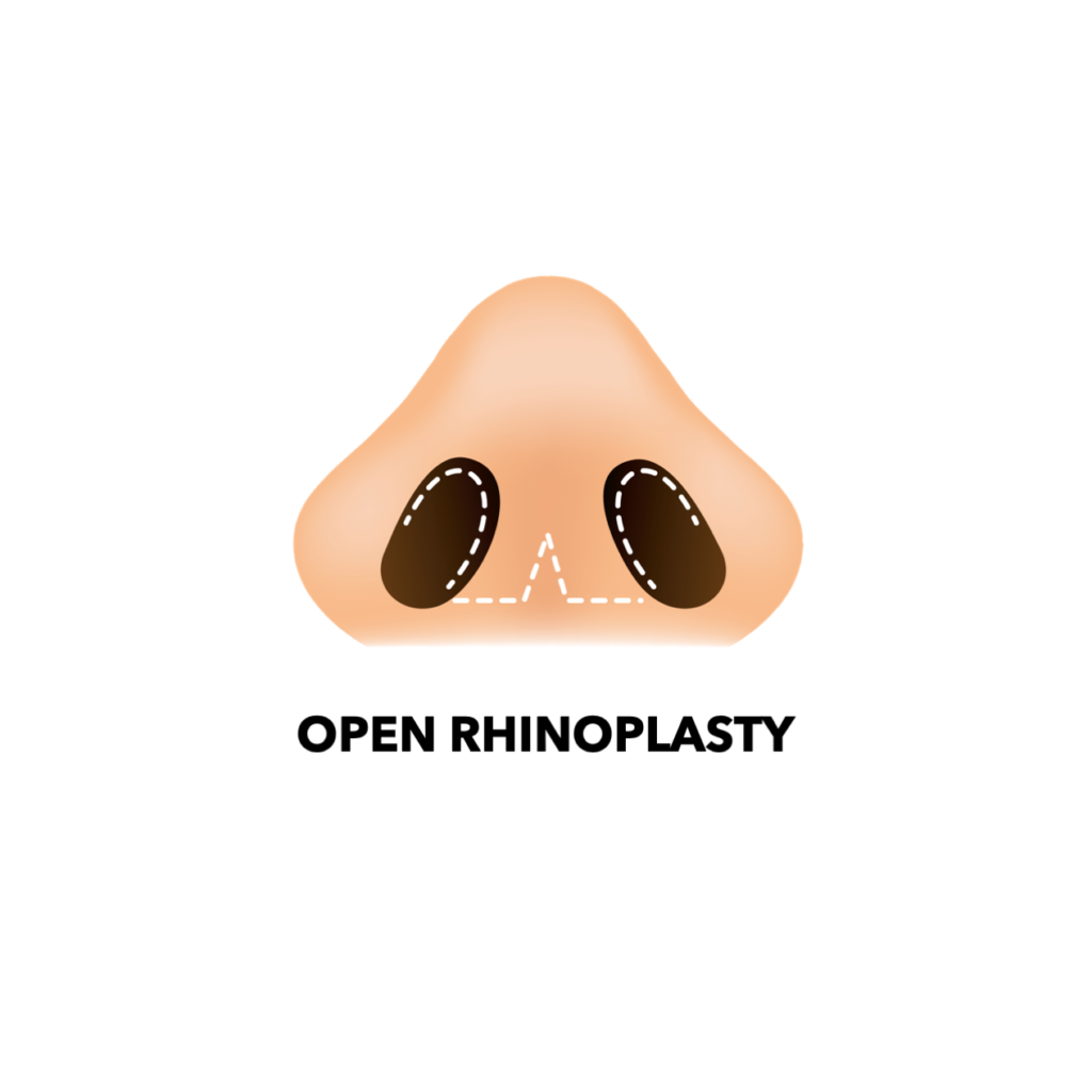 Open Rhinoplasty