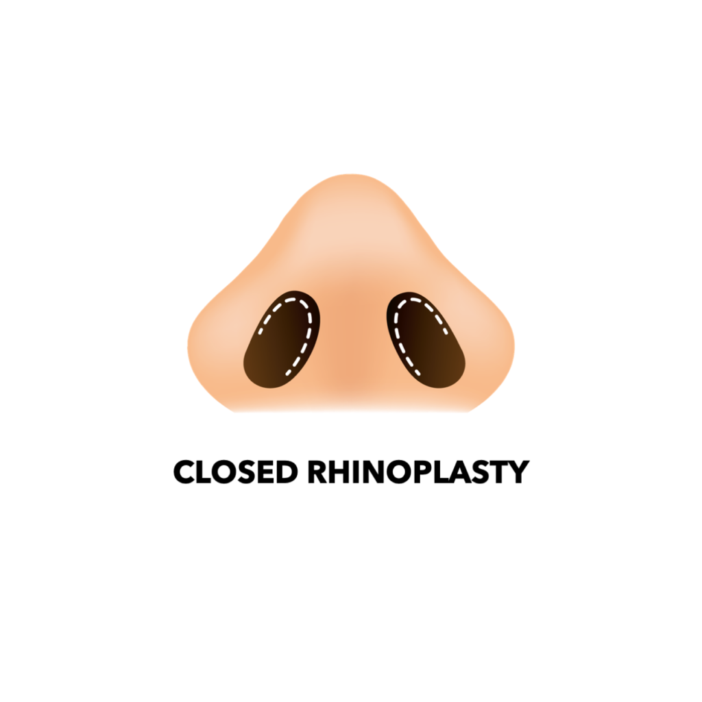 Closed Rhinoplasty