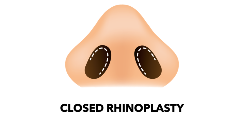 內开式隆鼻（Closed Rhinoplasty）