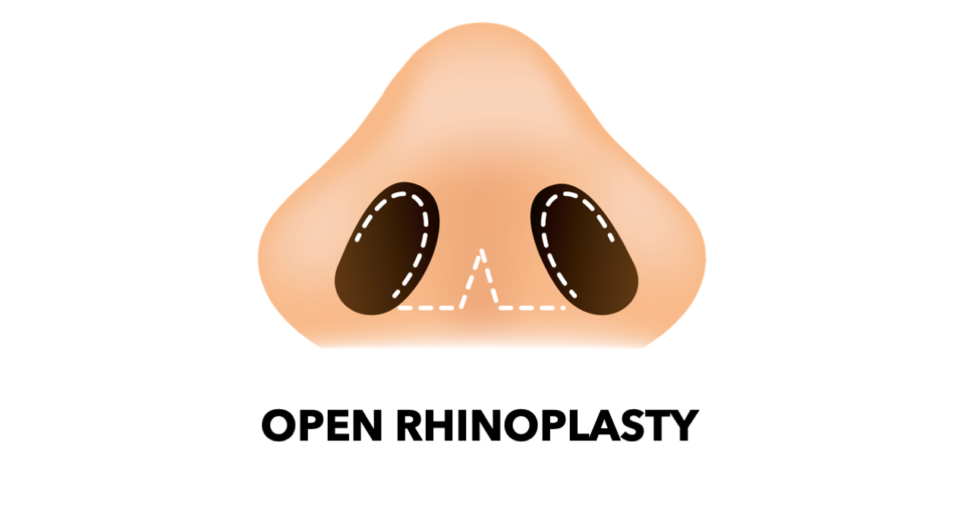 开放式隆鼻 Opened Rhinoplasty